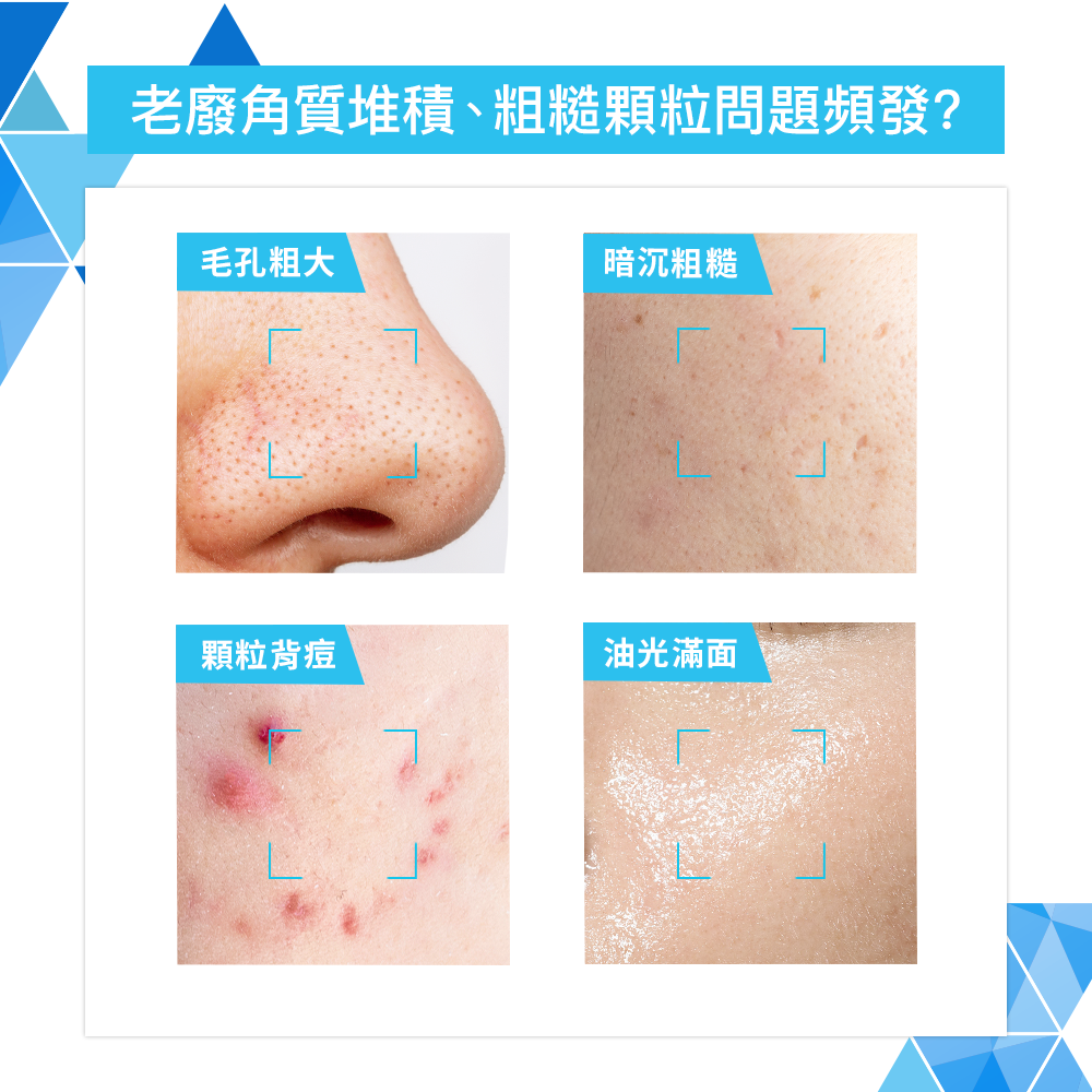 老廢角質堆積、粗糙顆粒問題頻發?